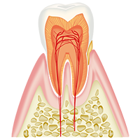 歯肉炎の歯