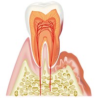 中程度の歯周病の歯
