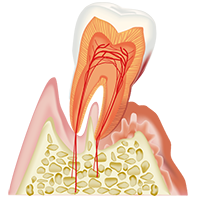 重度の歯周病の歯